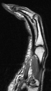 Figure 3 for case A2 pulley rupture finger (RID2437)